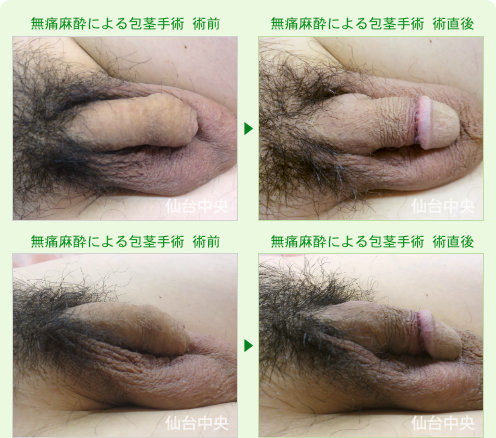 無痛麻酔による包茎手術 症例写真1