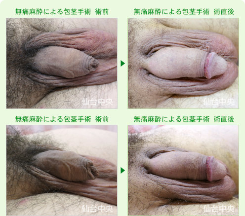 無痛麻酔による包茎手術 症例写真2