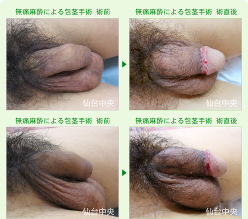無痛麻酔による包茎手術 症例写真3
