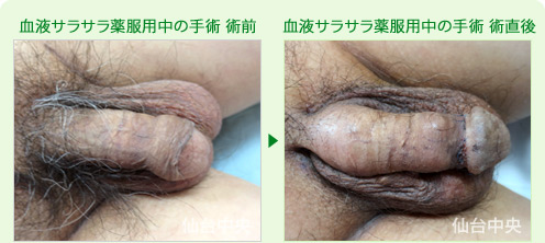 血液サラサラ薬服用中の手術 症例写真1