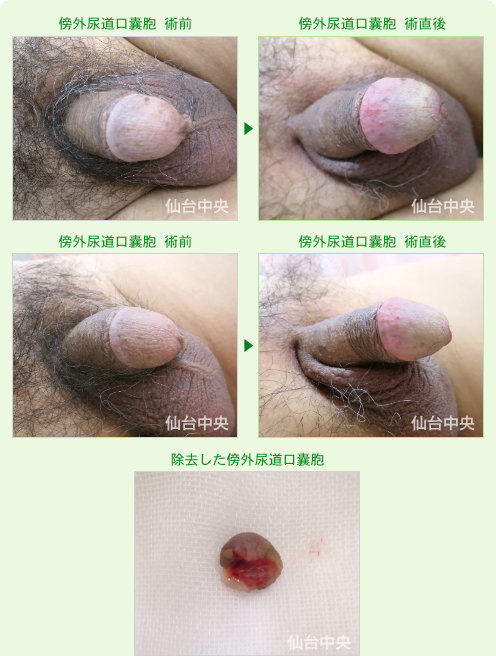 傍外尿道口嚢胞 症例写真