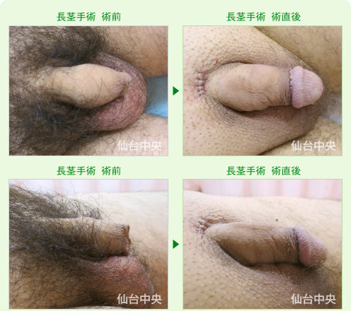 包茎、長茎、短小同時手術症例写真。術前と術直後 - 50代男性