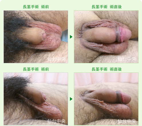 他院で断られた長茎手術症例写真。術前と術直後 - 30代男性