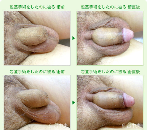 包茎手術をしたのに被る