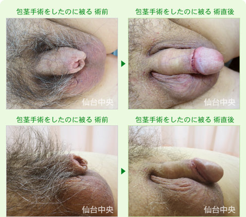包茎手術をしたのに被る