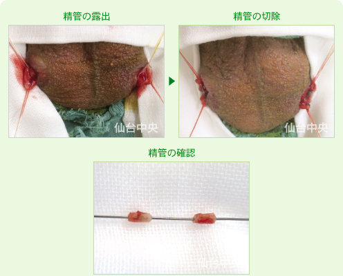 パイプカット手術 症例写真