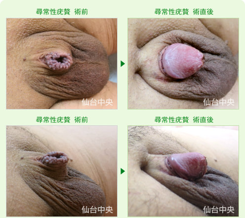 尋常性疣贅 症例写真